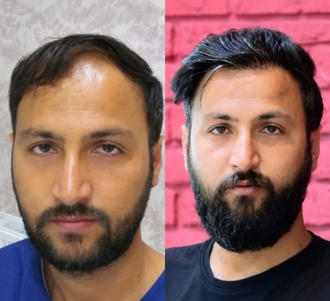 قبل و بعد کاشت مو